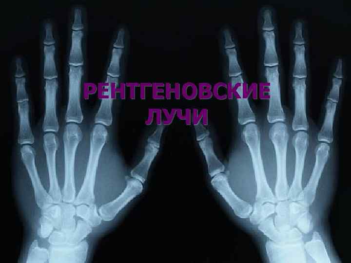 РЕНТГЕНОВСКИЕ ЛУЧИ 