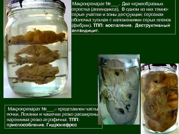 Макропрепарат №___. Два червеобразных отростка (аппендикса), В одном из них темносерые участки и зоны