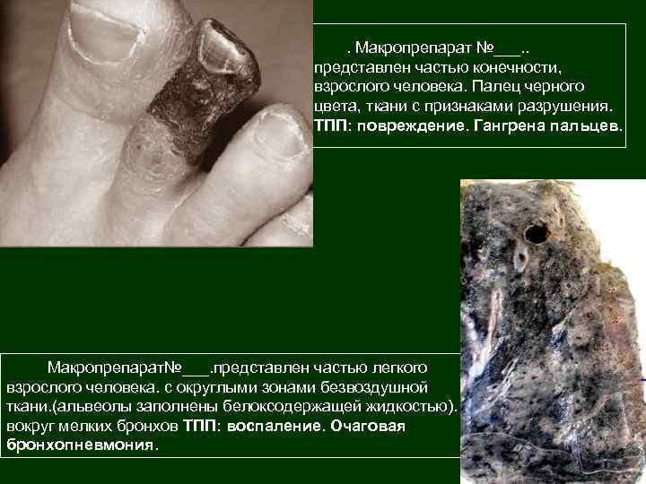 . Макропрепарат №___. . представлен частью конечности, взрослого человека. Палец черного цвета, ткани с