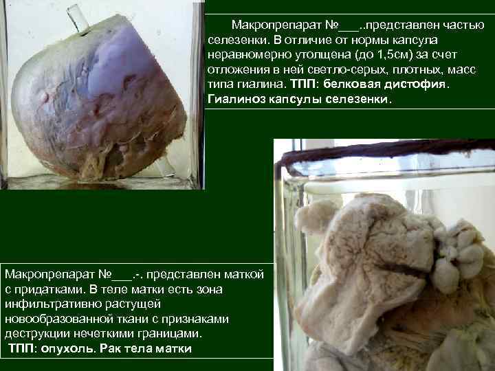 Макропрепарат №___. . представлен частью селезенки. В отличие от нормы капсула неравномерно утолщена (до