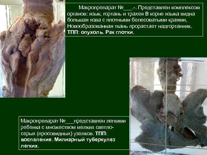 Макропрепарат №___. -. Представлен комплексом органов: язык, гортань и трахея В корне языка видна