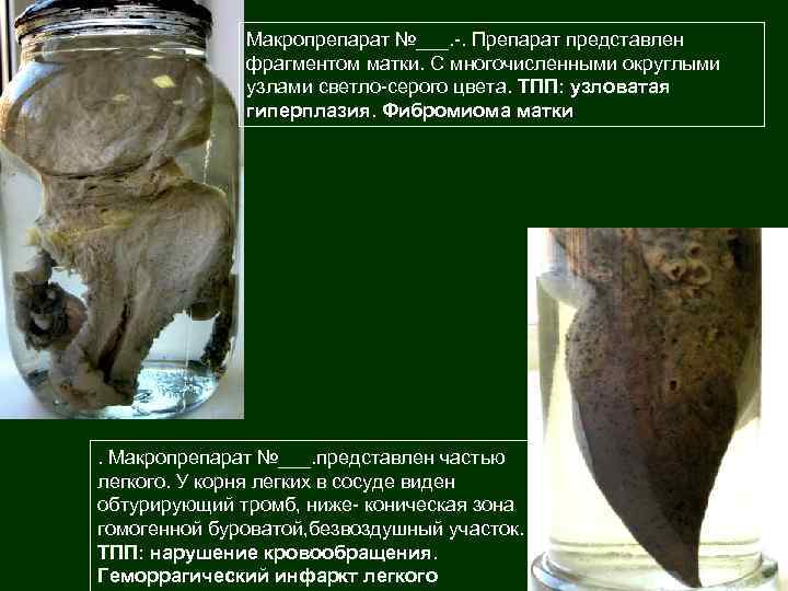 Макропрепарат №___. -. Препарат представлен фрагментом матки. С многочисленными округлыми узлами светло-серого цвета. ТПП: