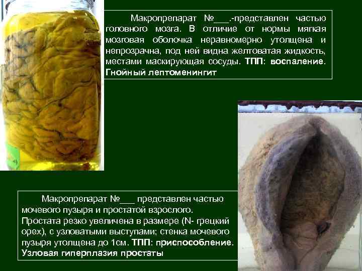 Макропрепарат №___. -представлен частью головного мозга. В отличие от нормы мягкая мозговая оболочка неравномерно