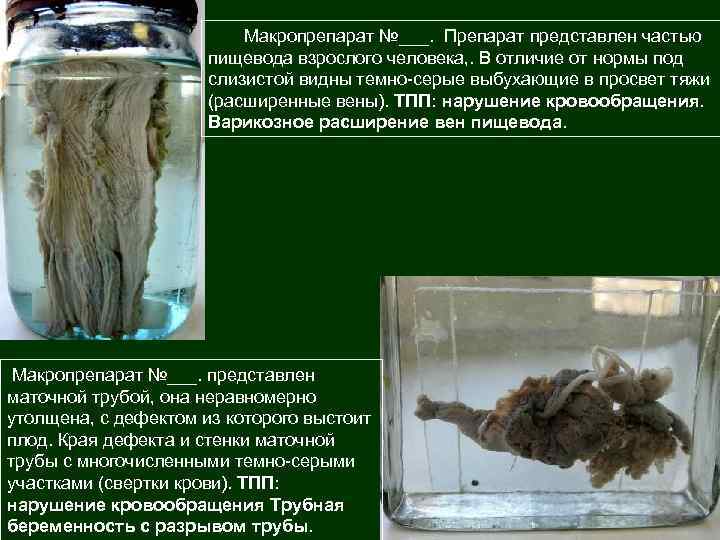 Макропрепарат №___. Препарат представлен частью пищевода взрослого человека, . В отличие от нормы под