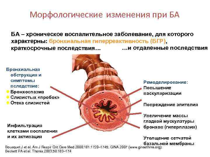 Морфологические изменения при БА БА – хроническое воспалительное заболевание, для которого характерны: бронхиальная гиперреактивность