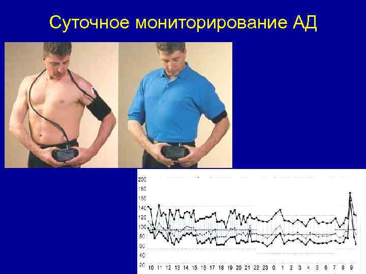 Суточное мониторирование АД 