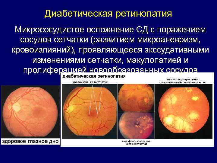 Диабетическая ретинопатия Микрососудистое осложнение СД с поражением сосудов сетчатки (развитием микроаневризм, кровоизлияний), проявляющееся экссудативными