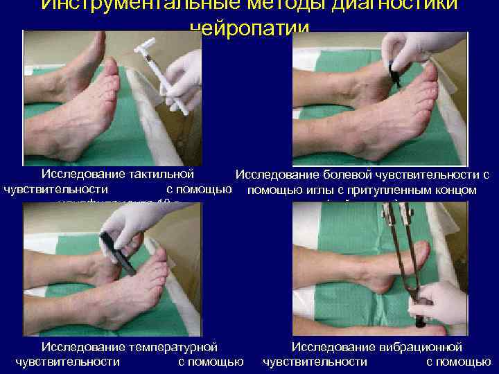 Инструментальные методы диагностики нейропатии Исследование тактильной Исследование болевой чувствительности с чувствительности с помощью иглы