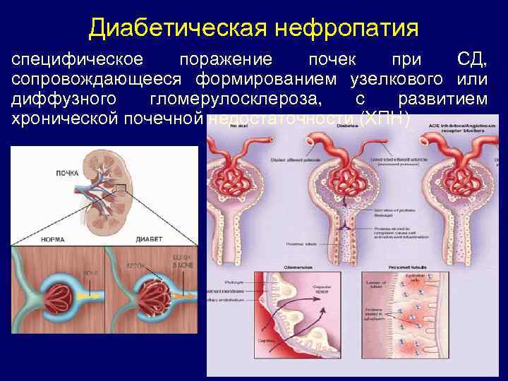Диабетическая нефропатия специфическое поражение почек при СД, сопровождающееся формированием узелкового или диффузного гломерулосклероза, с