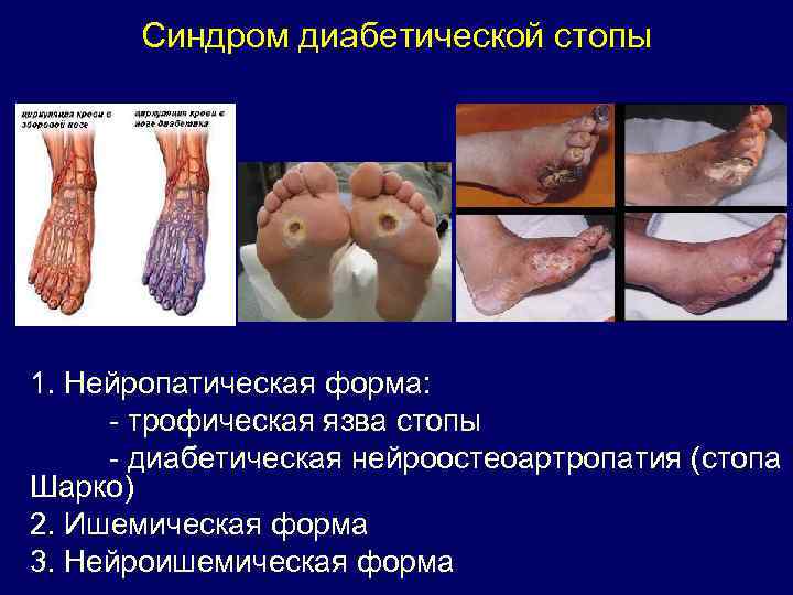 Синдром диабетической стопы 1. Нейропатическая форма: - трофическая язва стопы - диабетическая нейроостеоартропатия (стопа