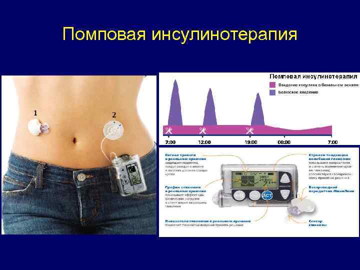 Помповая инсулинотерапия 