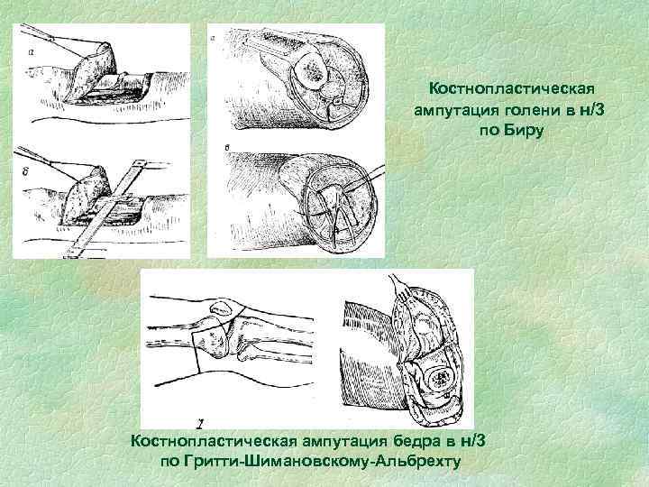 Костнопластическая ампутация голени в н/3 по Биру Костнопластическая ампутация бедра в н/3 по Гритти-Шимановскому-Альбрехту
