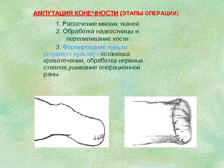 АМПУТАЦИЯ КОНЕЧНОСТИ (ЭТАПЫ ОПЕРАЦИИ) 1. Рассечение мягких тканей 2. Обработка надкостницы и перепиливание кости