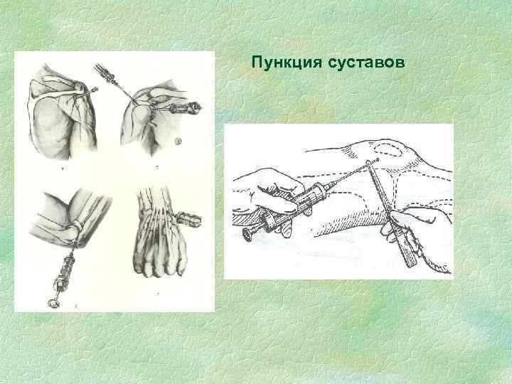 Пункция суставов 