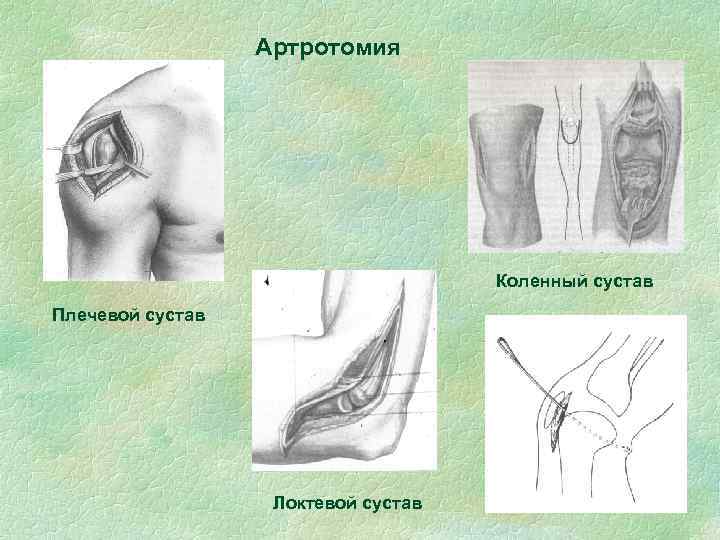 Артротомия Коленный сустав Плечевой сустав Локтевой сустав 