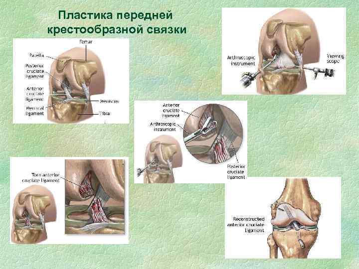 Пластика передней крестообразной связки 