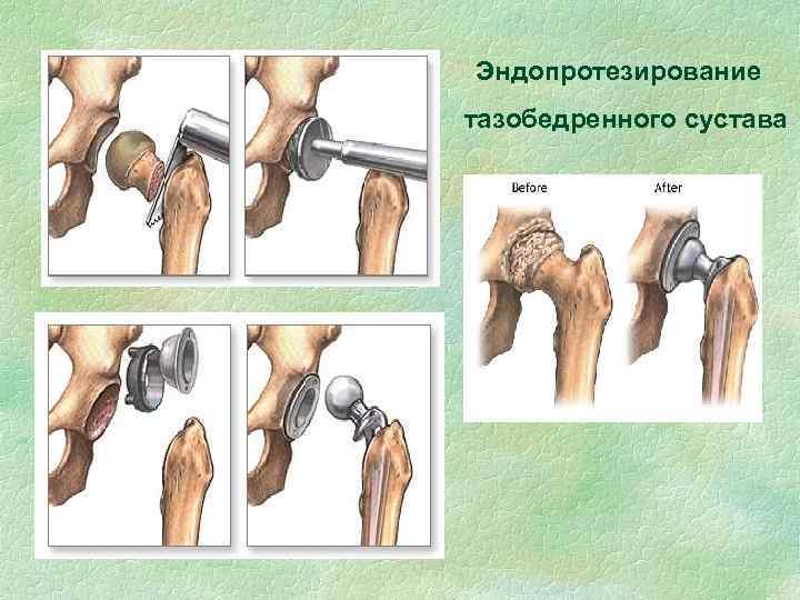 Эндопротезирование тазобедренного сустава 