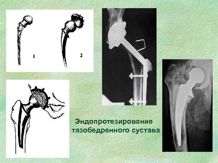 Эндопротезирование тазобедренного сустава 