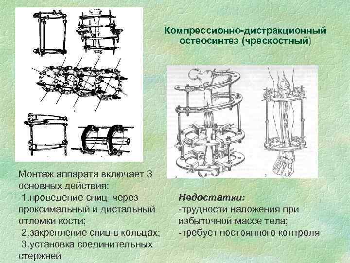 Компрессионно-дистракционный остеосинтез (чрескостный) Монтаж аппарата включает 3 основных действия: 1. проведение спиц через проксимальный
