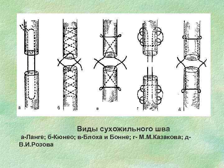 Виды сухожильного шва а-Ланге; б-Кюнео; в-Блоха и Бонне; г- М. М. Казакова; д. В.