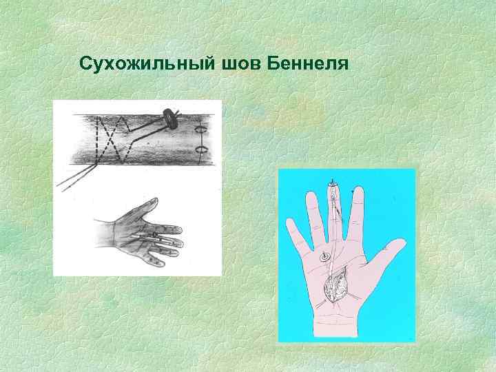 Сухожильный шов Беннеля 