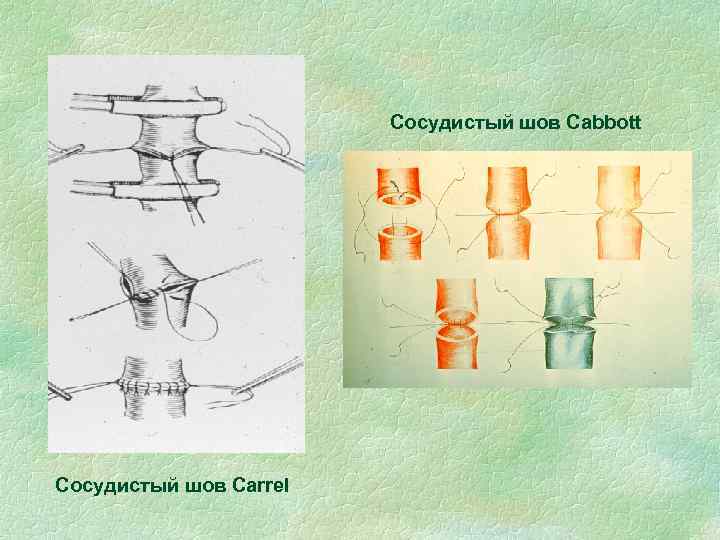 Сосудистый шов Cabbott Сосудистый шов Carrel 