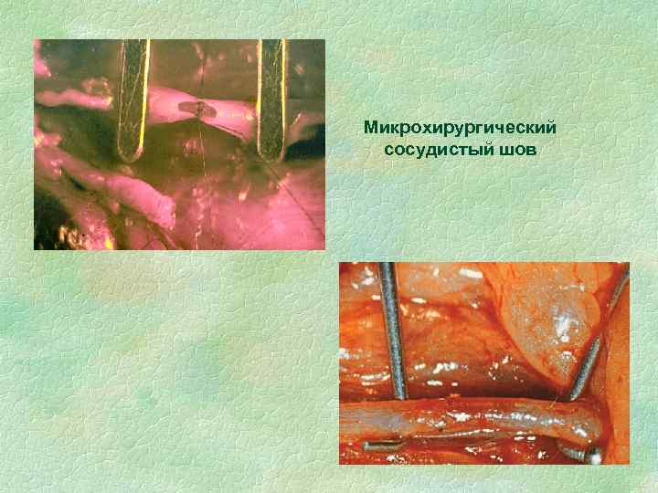 Микрохирургический сосудистый шов 