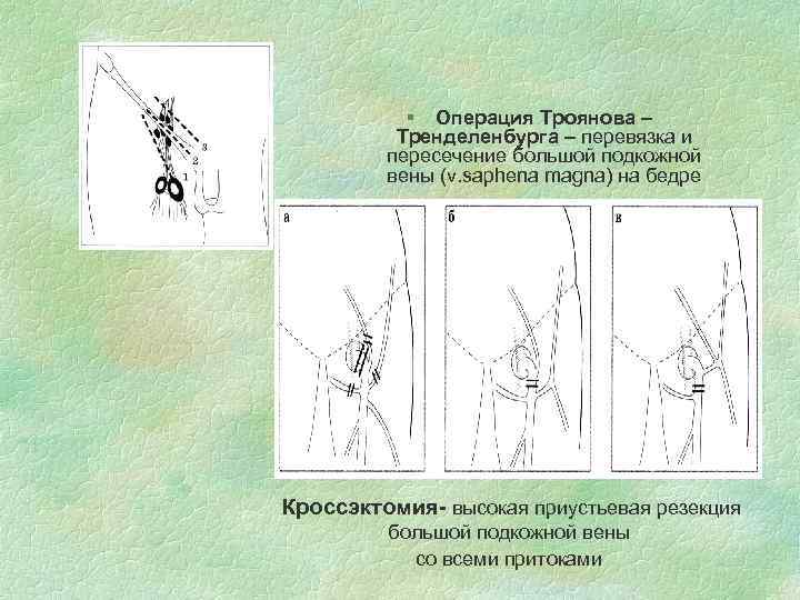 § Операция Троянова – Тренделенбурга – перевязка и пересечение большой подкожной вены (v. saphena
