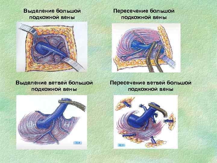 Выделение большой подкожной вены Выделение ветвей большой подкожной вены Пересечение ветвей большой подкожной вены
