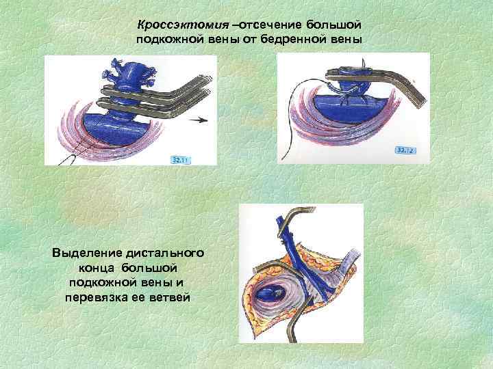Кроссэктомия –отсечение большой подкожной вены от бедренной вены Выделение дистального конца большой подкожной вены
