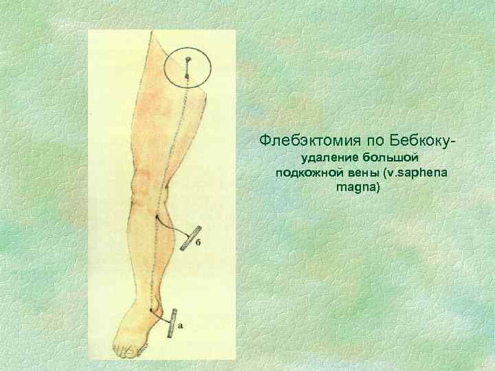 Флебэктомия по Бебкокуудаление большой подкожной вены (v. saphena magna) 