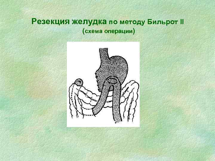 Резекция желудка по методу Бильрот II (схема операции) 