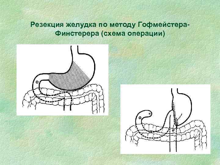 Резекция желудка по методу Гофмейстера. Финстерера (схема операции) 