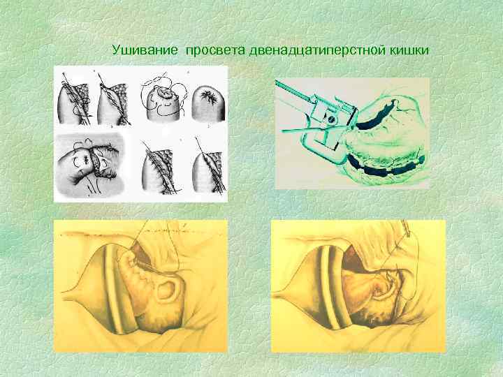 Ушивание просвета двенадцатиперстной кишки 