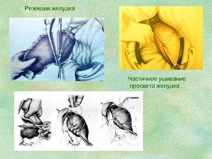 Резекция желудка Частичное ушивание просвета желудка 