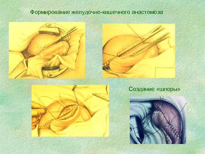 Формирование желудочно-кишечного анастомоза Создание «шпоры» 