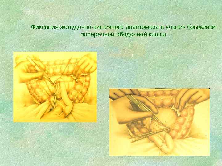 Фиксация желудочно-кишечного анастомоза в «окне» брыжейки поперечной ободочной кишки 