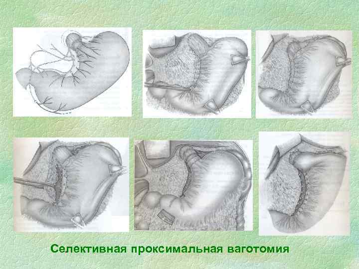 Селективная проксимальная ваготомия 