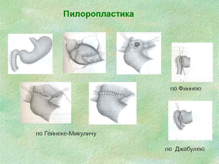 Пилоропластика по Финнею по Гейнеке-Микуличу по Джабулею 