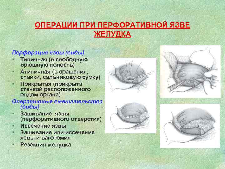 ОПЕРАЦИИ ПРИ ПЕРФОРАТИВНОЙ ЯЗВЕ ЖЕЛУДКА Перфорация язвы (виды) § Типичная (в свободную брюшную полость)