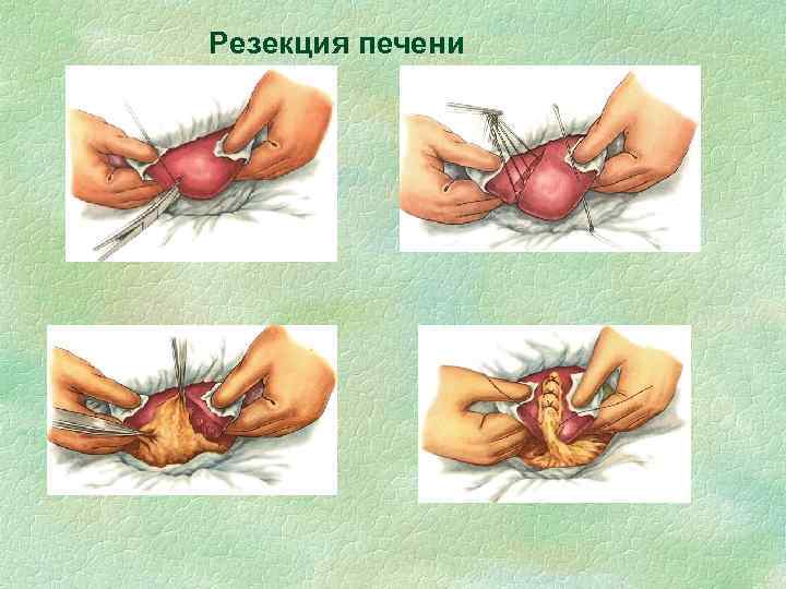 Резекция печени 