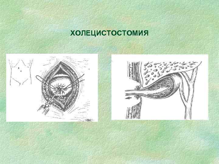 ХОЛЕЦИСТОСТОМИЯ 