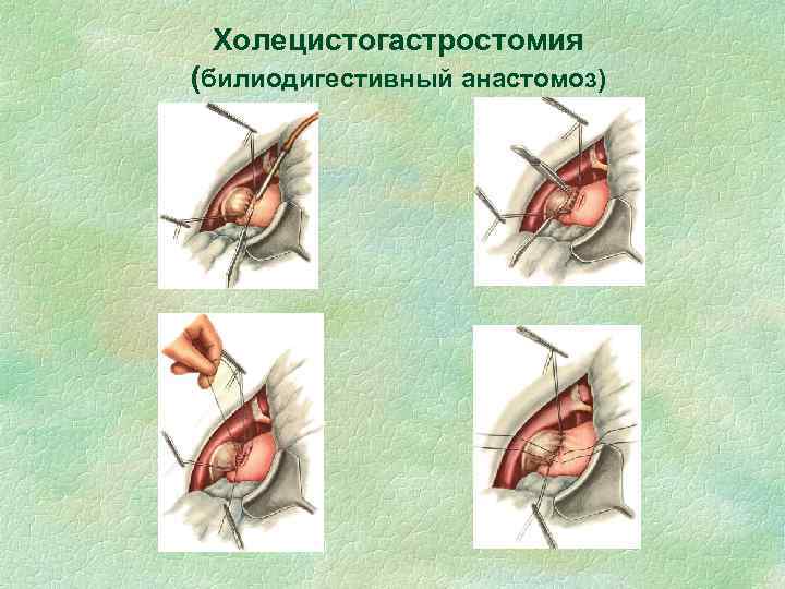 Холецистогастростомия (билиодигестивный анастомоз) 