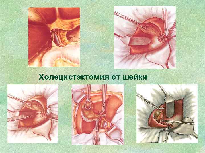 Холецистэктомия от шейки 