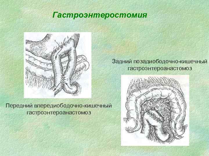 При диспептических нарушениях на фоне замедленного опорожнения желудка применяют