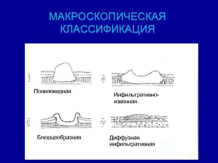МАКРОСКОПИЧЕСКАЯ КЛАССИФИКАЦИЯ Полиповидная Блюдцеобразная Инфильтративноязвенная Диффузная инфильтративная 