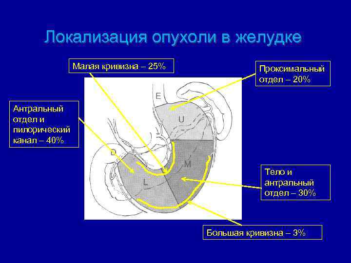 Локализация опухоли в желудке Малая кривизна – 25% Проксимальный отдел – 20% Антральный отдел
