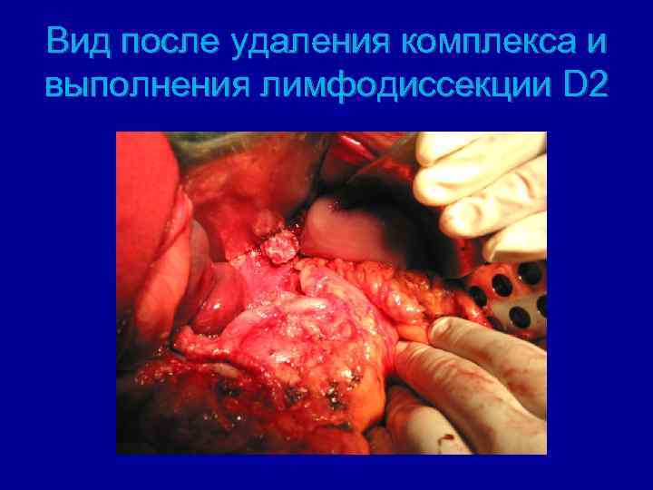 Вид после удаления комплекса и выполнения лимфодиссекции D 2 