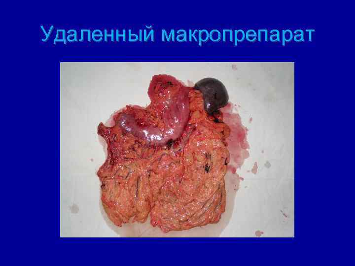 Удаленный макропрепарат 