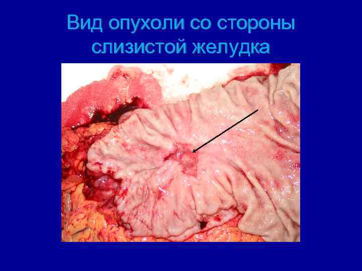 Вид опухоли со стороны слизистой желудка 